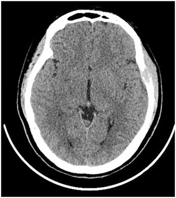 Cranial Rosai-Dorfman disease: a case report and literature review